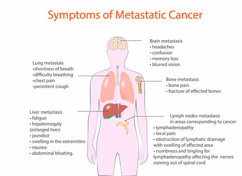 symptoms of metastatic cancer, vector, medical diagram