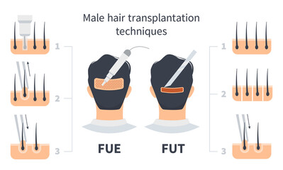 Male hair transplantation FUE and FUT comparison, stages of Follicular Unit Extraction. Treatment of baldness, alopecia and hair loss. Vector medical infographic, man's head scalp
