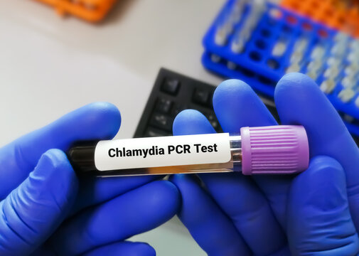 Chlamydia PCR test or  polymerase chain reaction for Chlamydia to detect STD