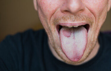 man with tongue disease, has a wound, close-up photo on face