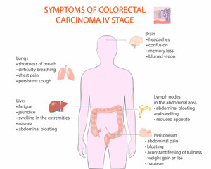Symptoms of coloretal carcinoma IV stage, vector, medical diagram