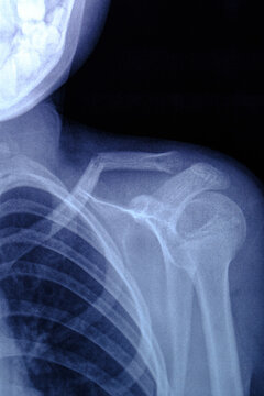 X-ray image broken collarbone person.