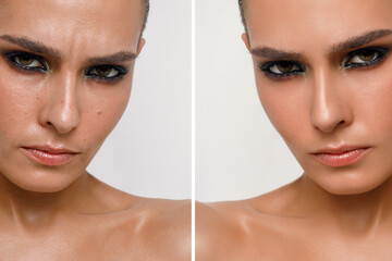 Nevus, hyperhidrosis and enlarged pores on a woman's face close-up, female problem skin. Before and...
