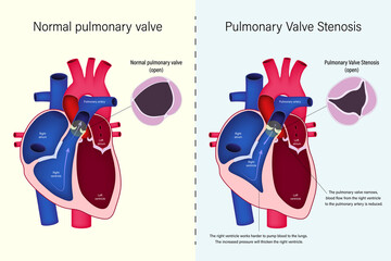 The difference of normal pulmonary valve and pulmonary valve stenosis vector. Congenital heart disease. - obrazy, fototapety, plakaty