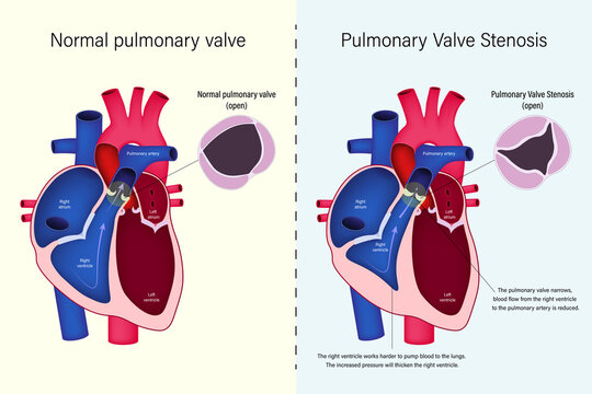 The difference of normal pulmonary valve and pulmonary valve stenosis vector. Congenital heart disease.