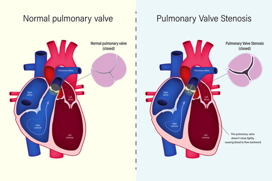 The difference of normal pulmonary valve and pulmonary valve stenosis vector. Congenital heart disease.
