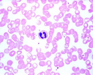 Human blood smear. Neutrophil