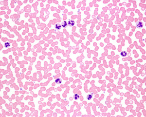 Human blood smear. Leukocytosis