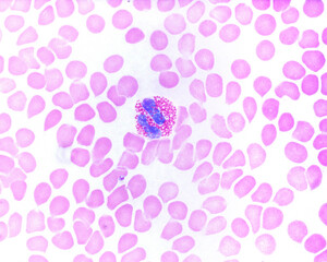 Human blood smear. Eosinophil