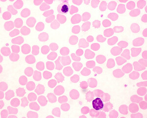 Human blood smear. Lymphocyte and erythroblast