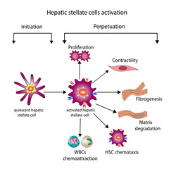 hepatic stellate cell (HSC) activation involving initiation and perpetuation processes.  Hepatic fibrosis, liver fibrosis pathogenesis - obrazy, fototapety, plakaty