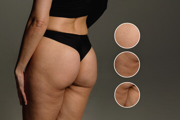 Buttocks and hips woman with cellulite and stretch marks close-up before liposuction procedure and cosmetic therapy - obrazy, fototapety, plakaty