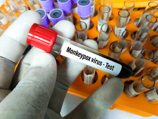 Blood sample tube for Monkeypox virus test. It is also known as the Moneypox virus, is a...