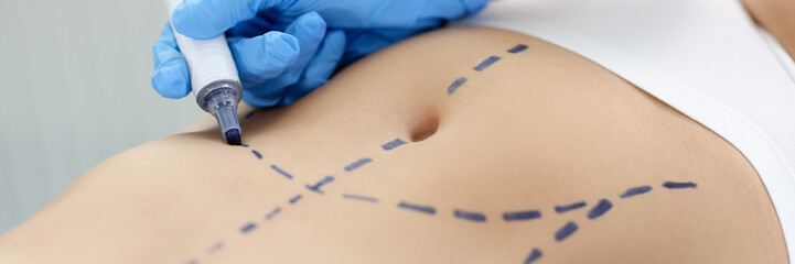 Doctor drawing preoperative marking on patient abdomen closeup