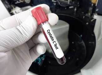 Blood sample tube for cystatin C test, diagnosis for renal disease, kidney disease