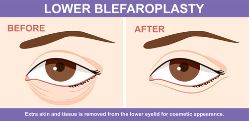 Lower Blepharoplasty of eyelid , before and after. Vector illustration with plastic eyelid surgery. Infographics with icons of plastic surgery procedures. - obrazy, fototapety, plakaty