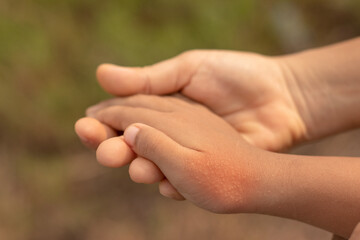 Red spots on the skin of the hands of a child. children's allergy. Dryness and irritation of the...