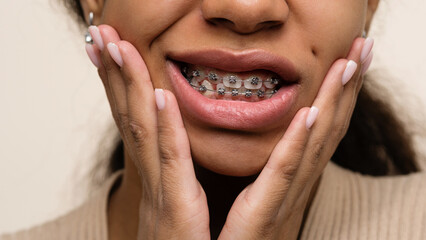 Orthodontic treatment. Teeth with braces