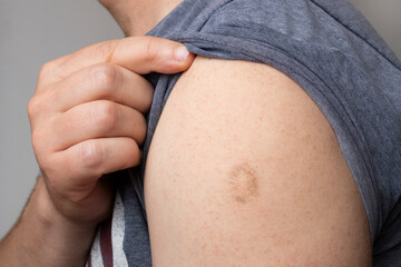 Monkeypox and smallpox vaccine scar on young man's arm - obrazy, fototapety, plakaty