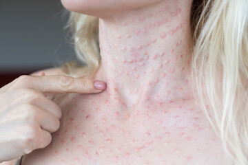 Papules after beauty injections on the face. Closeup photo