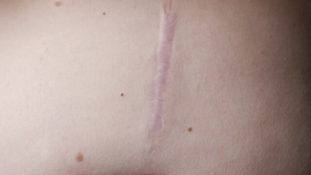 Surgery scar on female belly above navel. Long scar after surgery on female abdomen. Postoperative scar on woman skin caused by operation, extreme closeup