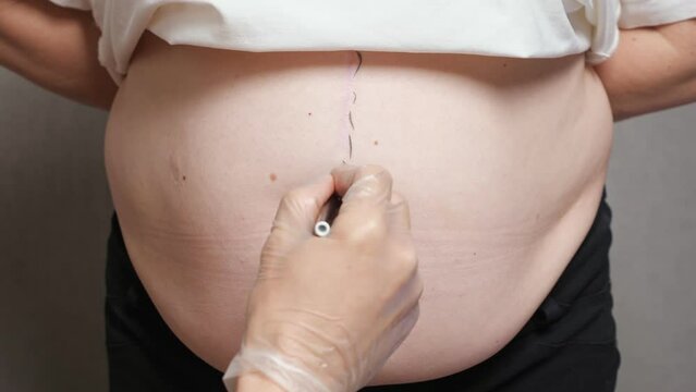 Surgeon draws correction marks on female sagging belly for plastic surgery. Black surgery lines for liposuction procedure on patient fat belly, closeup