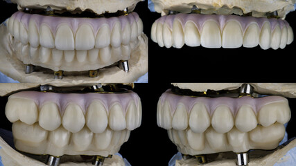 dental prosthesis of the upper jaw from zircon on a model from different sides with a painted gum in the form of a collage of four photos © Dental Pro Content