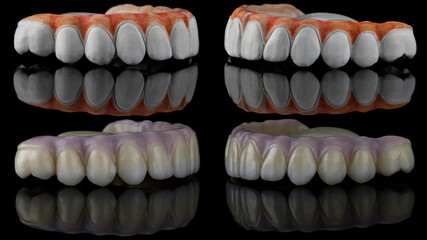 excellent dental collage of a zircon prosthesis, before and after fabrication by a technician on a...