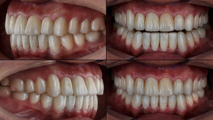 dental collage of intraoral photos with veneers on the upper and lower jaws