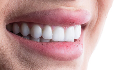 press ceramic crowns and veneers