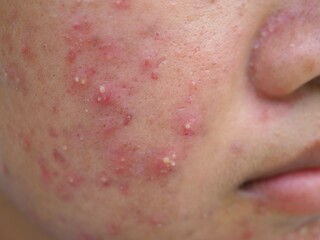 Fototapeta premium Portrait of ugly teenage girl having problems of acne inflammation on her face. concept of facial care products. closeup photo, blurred.