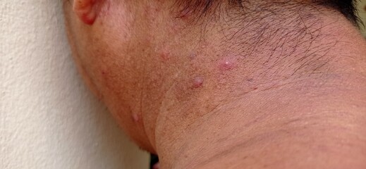 Man with inflammatory acne on the nape of the neck.