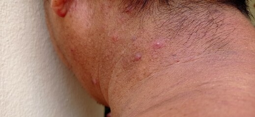 Naklejka premium Man with inflammatory acne on the nape of the neck.