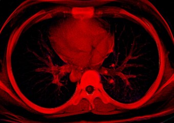 Colored 3d chest ct scan showing heart,lung, vascular, liver, and bowel