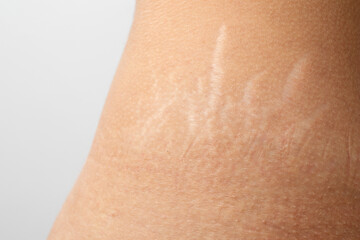 Stretch marks on the body skin of female thighs