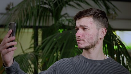 A close-up of a young man with problematic skin taking a selfie on his smartphone. Problematic skin