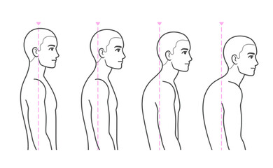 Spine kyphosis progression stages