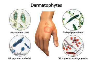 Hand fungal infection, tinea manuum, 3D illustration