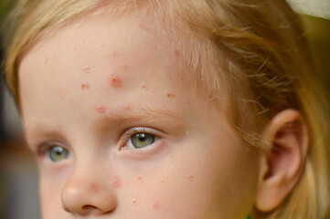 Close-up of a Caucasian girl with pimples and ulcers on her face. Monkeypox new disease dangerous over the world.