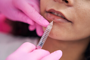 Syringe with lip augmentation is injected by a young lady