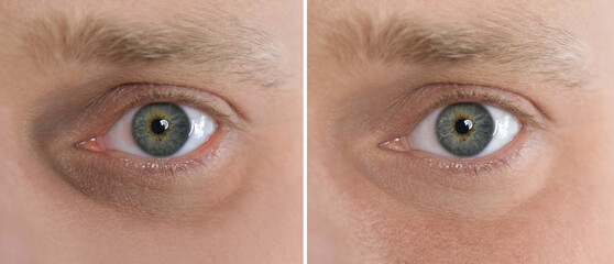 Collage with photos of tired man with dark circle under eye and after rest, closeup. Banner design