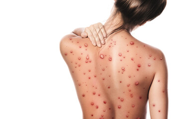 Female back affected by blistering rash because of monkeypox or other viral infectio