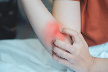 Woman scratching her arm due to irritation from insect bites.