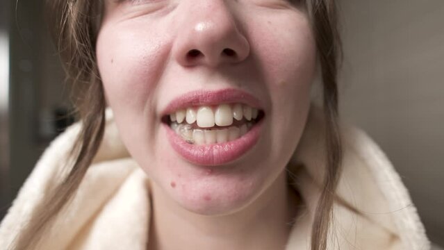 Close-up of a caucasian woman. Chin and mouth. The girl yawns. Correction of bite in young people with acne on the chin