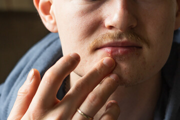 Caucasian blond man points her finger at his lips infected herpes virus. Indignation look. - obrazy, fototapety, plakaty