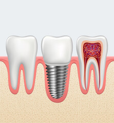 Set of realistic white healthy tooth, real tooth anatomy with nerves and blood vessels, caries broken tooth. Vector illustration