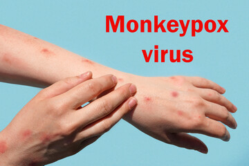 Monkeypox new disease dangerous over the world. Patient with Monkey Pox. Painful rash, red spots blisters on the hand. Close up rash, human hands with Health problem. The word Monkeypox virus