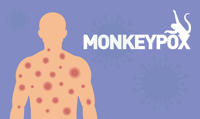 Multi-country monkeypox outbreak in non-endemic countries. Body wound, measles, chicken pox.