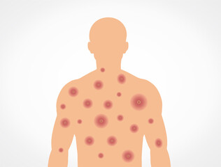 Monkeypox virus and alert against disease spread, symptoms. Monkey Pox virus outbreak.