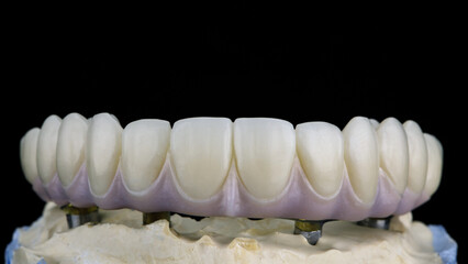 beautiful dental prosthesis of the upper jaw with artificial gums on a black background © Dental Pro Content